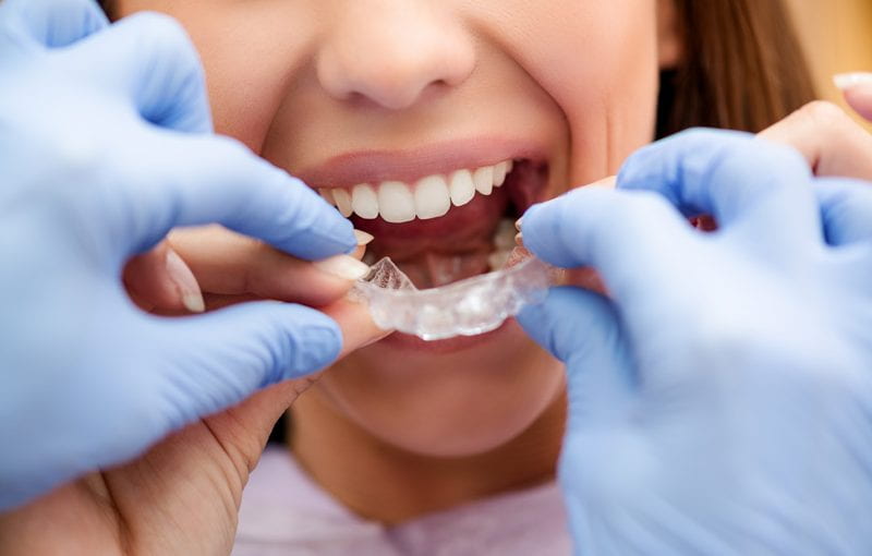 Dental Braces: Advantages of Invisalign
