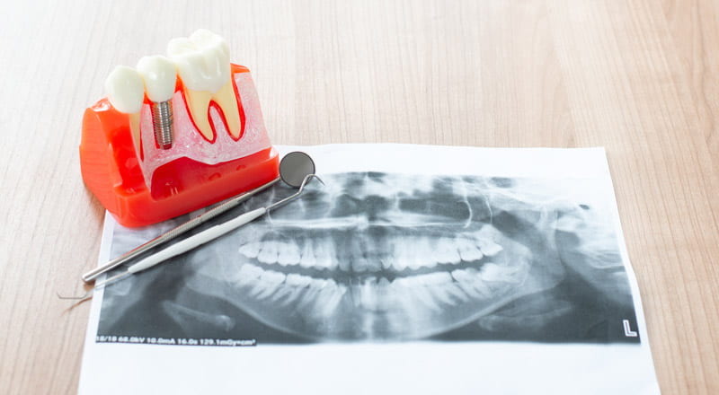 What are Dental Implants, and why do we need them?