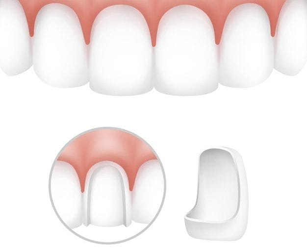 What is a CEREC crown, and how does it work?