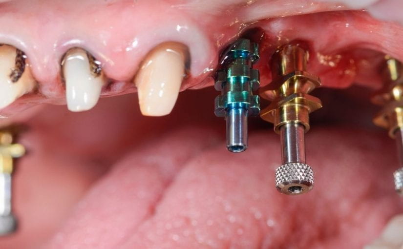 How many days does it take for Dental Implants?