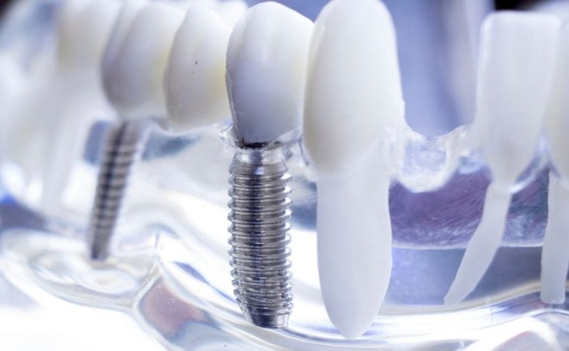 What are some dental implant centers in India?